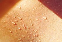 Hiperdroza sau transpiraţia excesivă, de la depresie la izolare socio-profesională