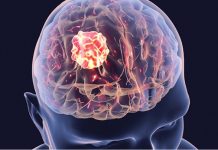 De ce doar unele tumori cerebrale răspund la imunoterapie?